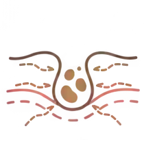 毛穴に皮脂や汚れが残った肌のイラスト